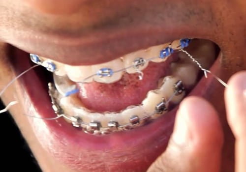 What to Do When Your Invisalign Braces Wire or Bracket Becomes Loose